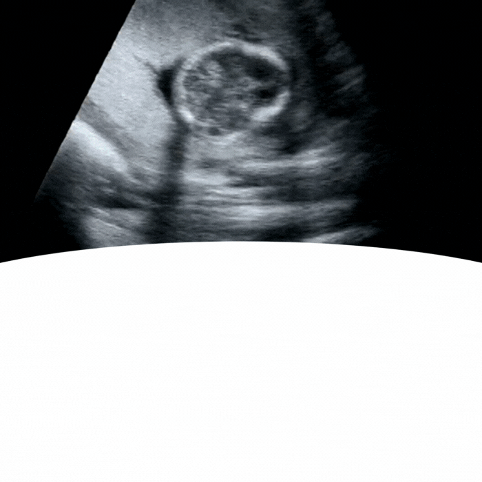 Babyvue Pregnancy Ultrasound Scans